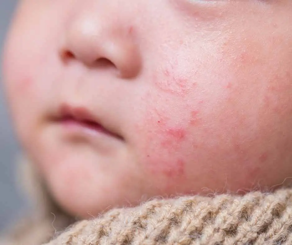 baby rashes
