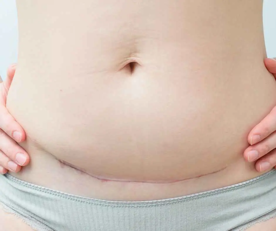 C Section – recovery from your Caesarean Birth